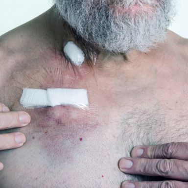 Port-Catheter-Infection